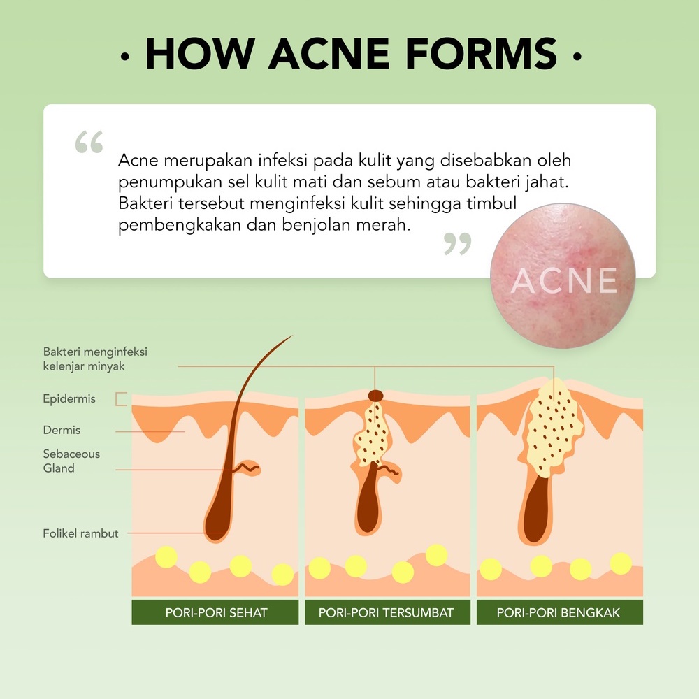 YOU AcnePlus Low pH Calming Cleanser 100ml | Triple Action Spot Care 15gr | Skin Defense Moisturizer 25gr | Complete Solution Serum 20ml | Balancing Skin Toner 100ml