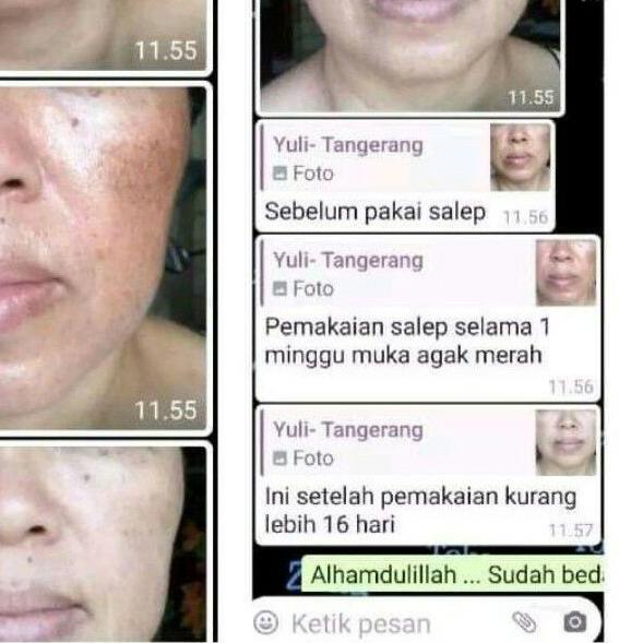 ✾ flek bandel liz skincare / flek hitam / cream flek / salep flek membandel ✫