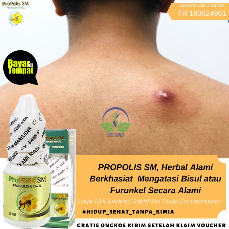 Obat Bisul Bisulan Di Area Intim Yang Alami Pada Anus Kelamin Kemaluan Dengan Propolis Sm Aman Shopee Indonesia