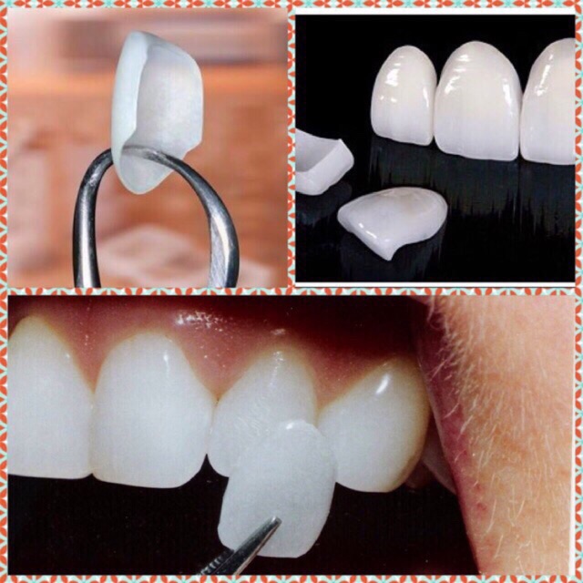 Veneer Gigi Isi 50 Venner Teeth Bunny Tooth Pelapis Cetakan Vener Putih Berseri Porcelen