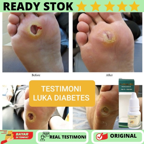 Obat Pengering Luka Diabetes, Obat Luka Diabetes Basah, Obat Luka Diabetes Basah, Obat Luka Diabetes