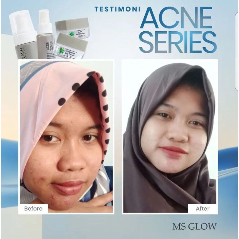 MS GLOW PAKET ACNE.