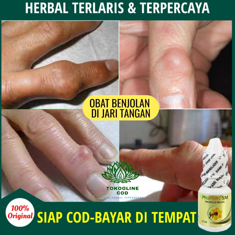 Obat Benjolan Di Jari Tangan Penghilang Benjolan Di Sendi Kaki Tangan Kista Ganglion Bunion Cod Shopee Indonesia