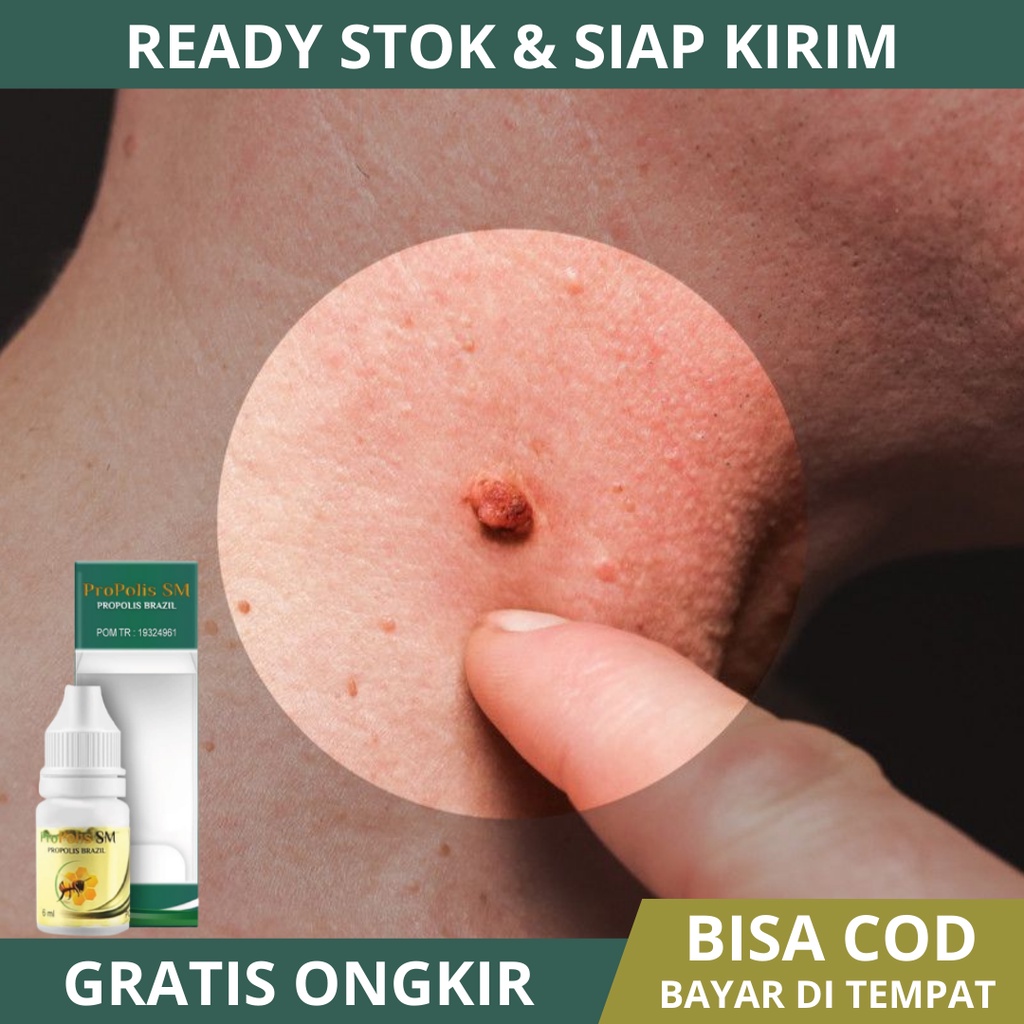 Obat Kutil, Obat Penghilang Kutil, Obat Kutil Di Leher, Obat Kutil Wajah, Obat Kutil Tangan, Obat Ku