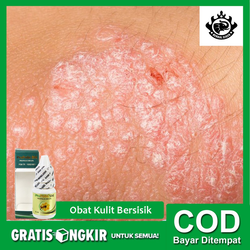 Obat Herbal Kulit Bersisik Kulit Kering Pecah Pecah Ruam Kulit Psoriasis Propolis Sm Bisa Cod Shopee Indonesia