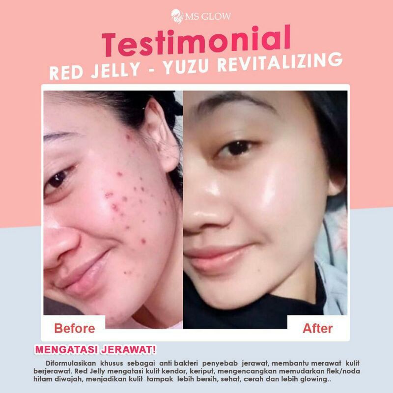 Yuzu Juice Moisturizer Ms Glow Untuk Menghilangkan Noda Hitam Bekas Jerawat Shopee Indonesia