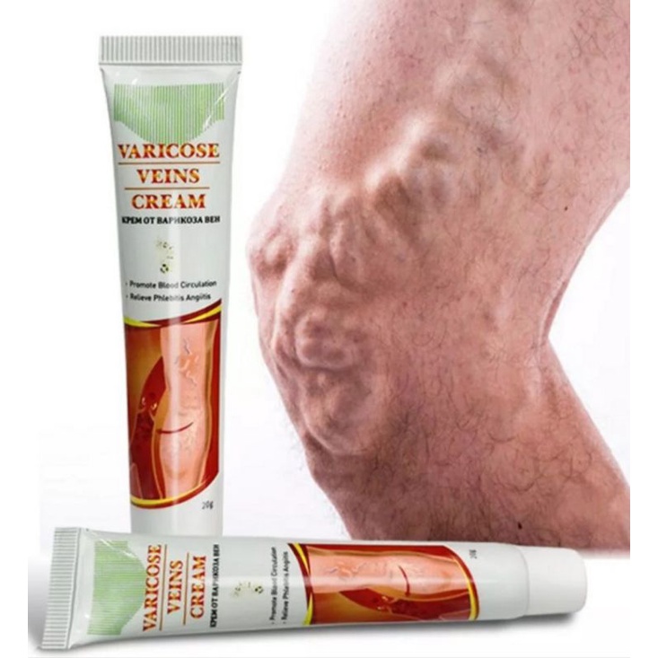 KRIM VARICOSE VEINS OBAT VARISES OBAT VARIKOKEL SALEP VARISES - VARICOSE