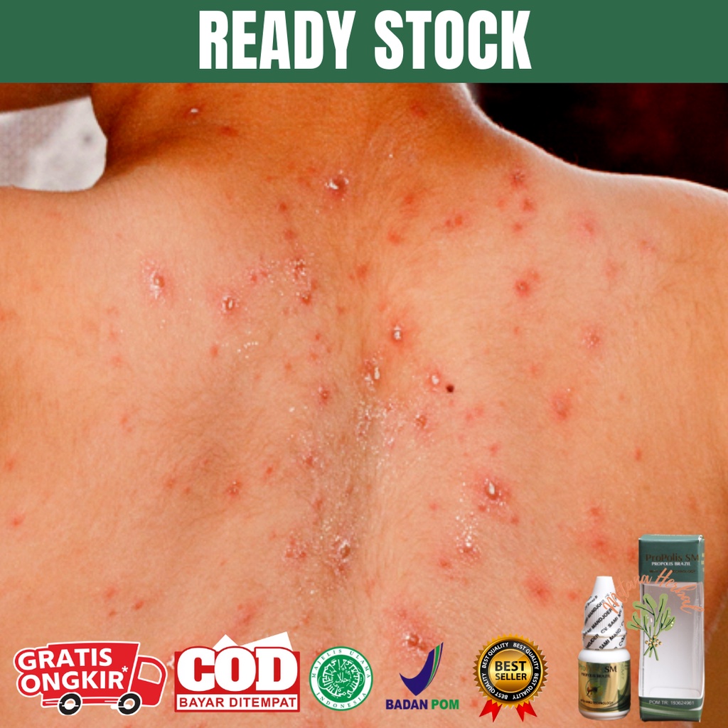 Obat Campak Karena Virus, Obat Campak Anak, Obat Campak, Ruam Merah Kulit, Bintik Merah Pada Kulit, 