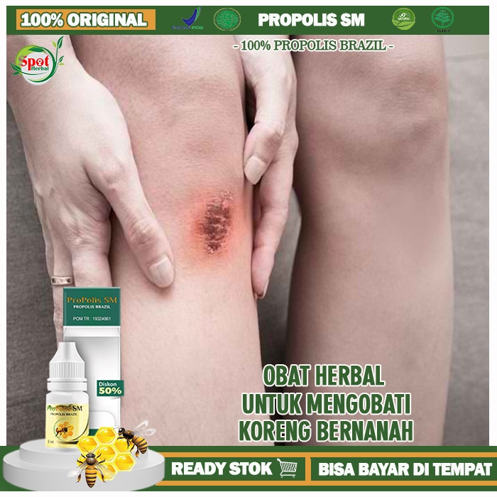 Obat Koreng Bernanah, Obat Korengan Di Kaki, Obat Korengan Di Kepala, Obat Korengan Di Wajah, Obat P
