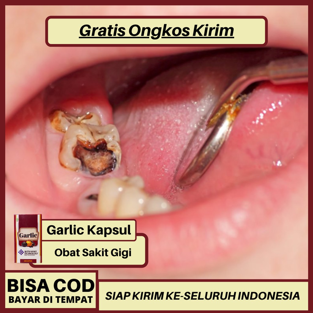 obat alami gusi bengkak karena gigi berlubang