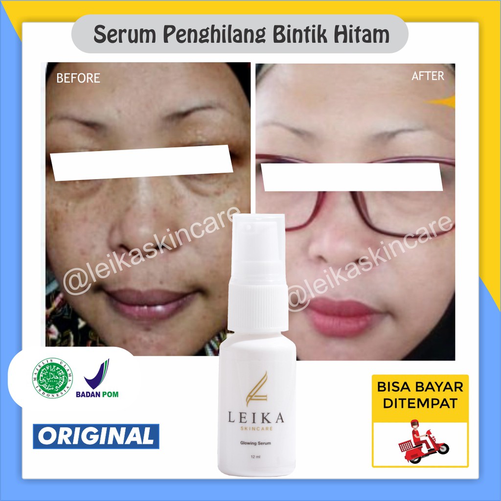 Serum Penghilang Bintik Hitam Di Wajah Membandel Menahun Perawatan Serum Flek Hitam BPOM ORI Halal S