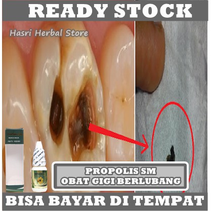 Obat Tetes / Kumur Sakit Gigi Berlubang, Obat Sakit Gigi Anak Dan Dewasa, Obat Sakit Gigi Alami, Obat Sakit Gigi Tradisional, Gusi Bengkak, Gigi Berdenyut, Gigi Berlubang Alami, Gigi ngilu, Gusi berdarah, Nyeri gusi Dengan Propolis SM 100% ORIGINAL ASLI