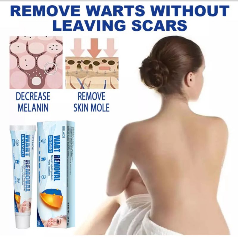 Salep Penghilang Kutil Badan Kutil Plantar skin tag Tahi lalat / Remover Wart