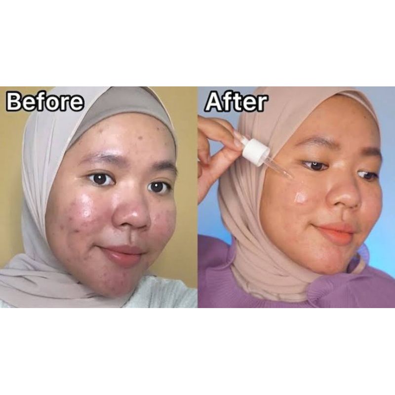 SCARLETT BRIGHTENING SERUM ACNE DAN SERUM BRIGHTLY - SCARLET BY FELICYA ANGELISTA