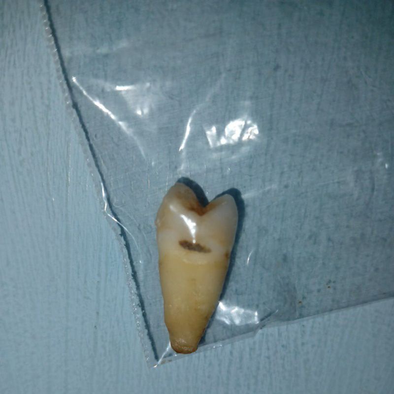 GIGI PREMOLAR 2 (GIGI ASLI)