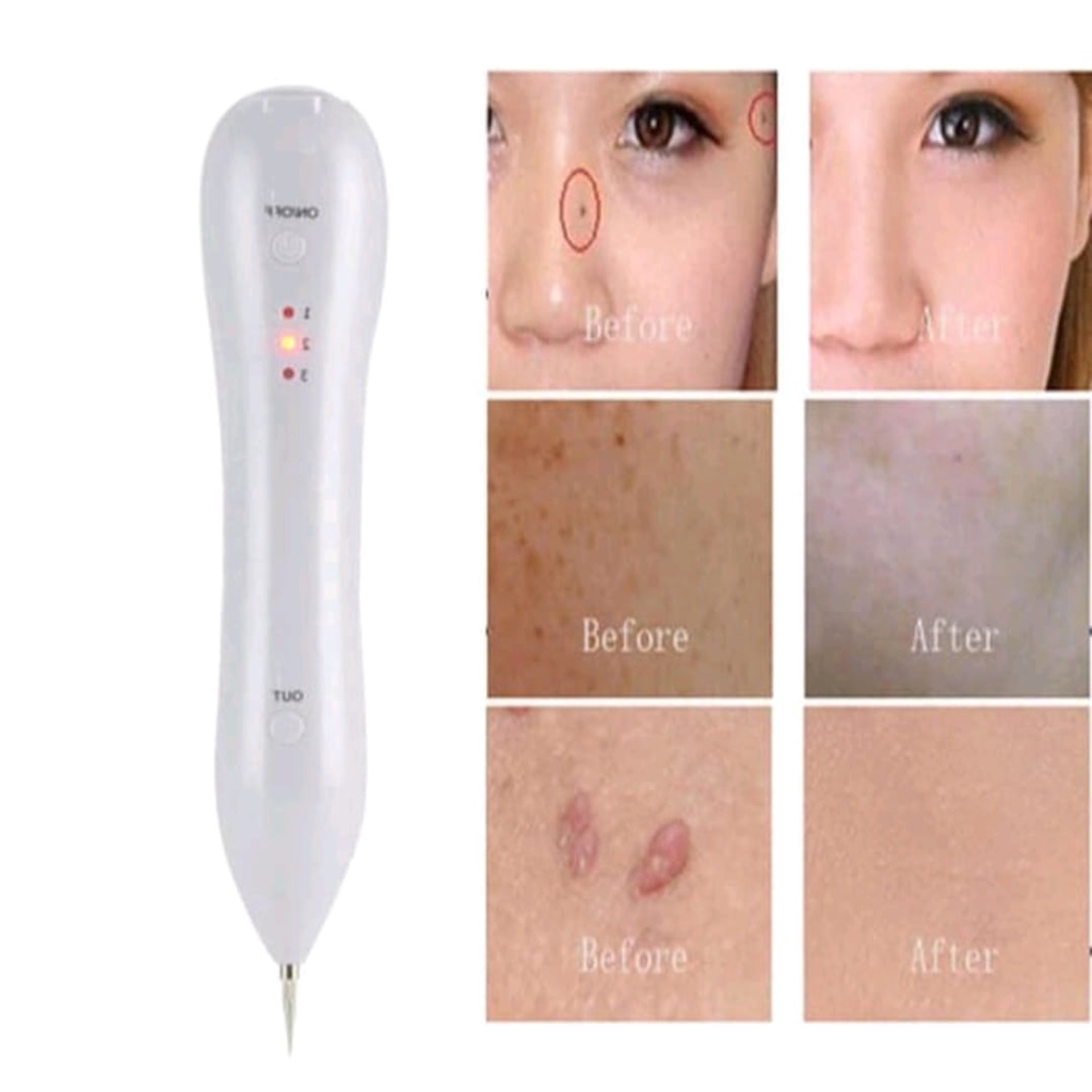 Laser Wajah Pen Mole Tatto Dark Spot Remover - JT060 - White OMHRBKWH