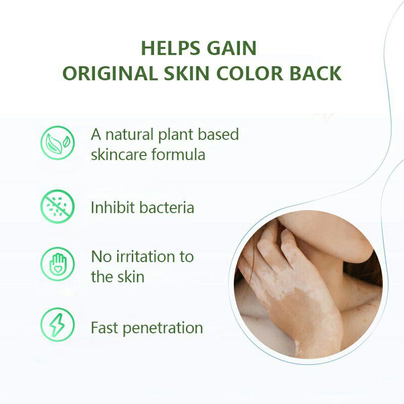 Sumifun Cream Salep Vitiligo Antibakteri