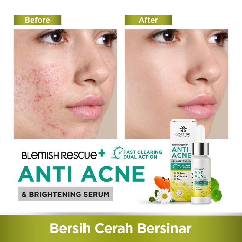 AZARINE Blemish Rescue Series / Acne Gentle Cleansing Foam / Anti Acne Serum Acne Spot Gel Oil Free