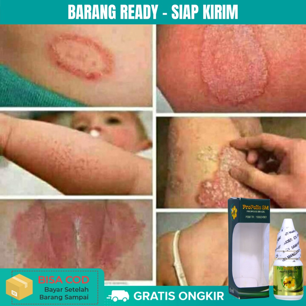 Obat Eksim, Eksim Basah, Eksim Kering Menahun, Gatal Selangkangan - Propolis SM