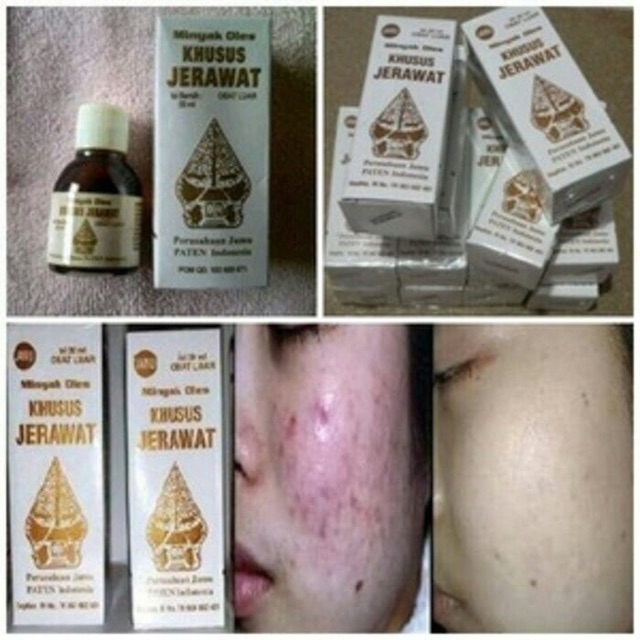 `ღ´ PHINKL `ღ´ Obat minyak jerawat cap wayang herbal organik ijin depkes PIRT