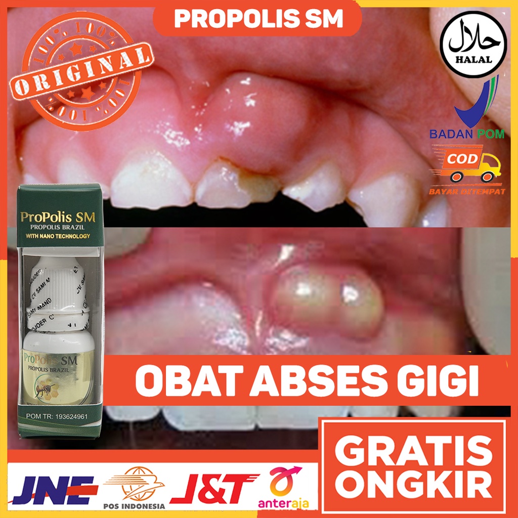 Obat Alami Abses Gigi Abses Gusi Kronis Sakit Gigi Ngilu Parah Gigi Berlubang Gusi Bengkak Bernanah