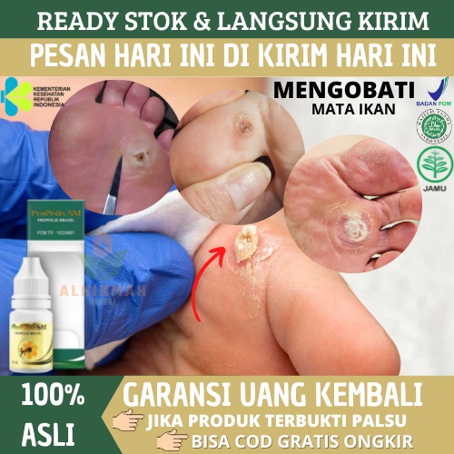 Obat Mata Ikan di Kaki Dan Tangan, Obat Mata Ikan di Telapak Kaki, Obat Perontok Mata Ikan, Obat Mat