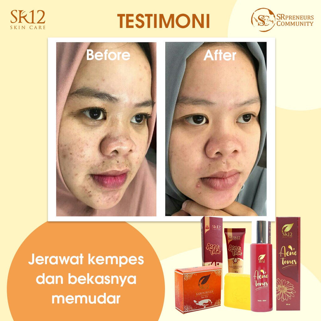 SR12 HERBAL SKINCARE ACNE TOTOL KRIM JERAWAT BPOM AMAN / MENGEMPESKAN JERAWAT / CREAM TUMPAS JERAWAT / PERAWATAN JERAWAT