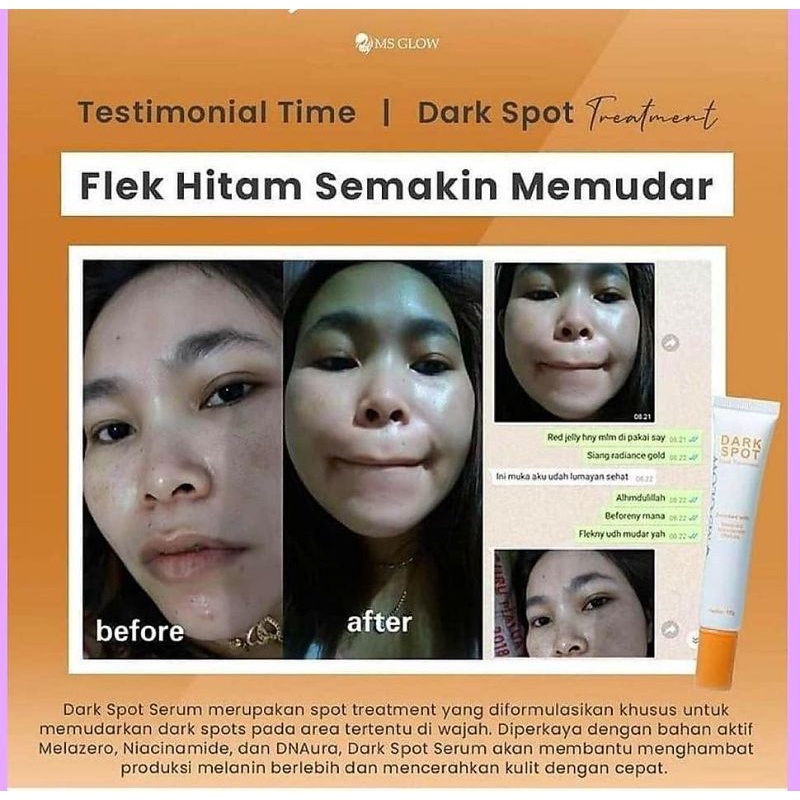 Dark Spot Treatment Serum II Khusus Flek MS GLOW