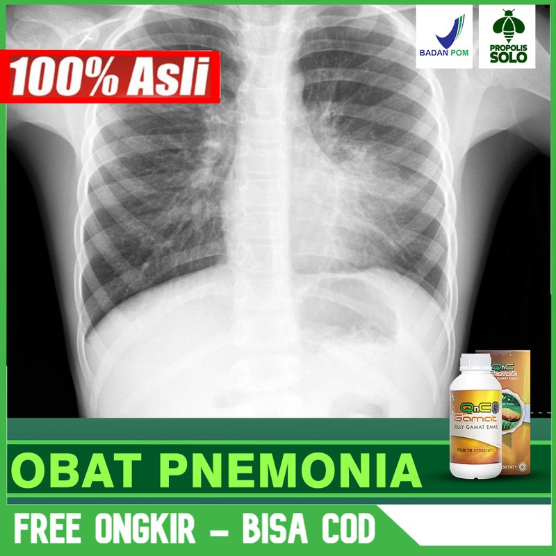 

Obat Pnemonia, Ifeksi Paru, Kanker Paru, Sesak Nafas Alami QNC Jelly Gamat Herbal Terlaris Bisa COD