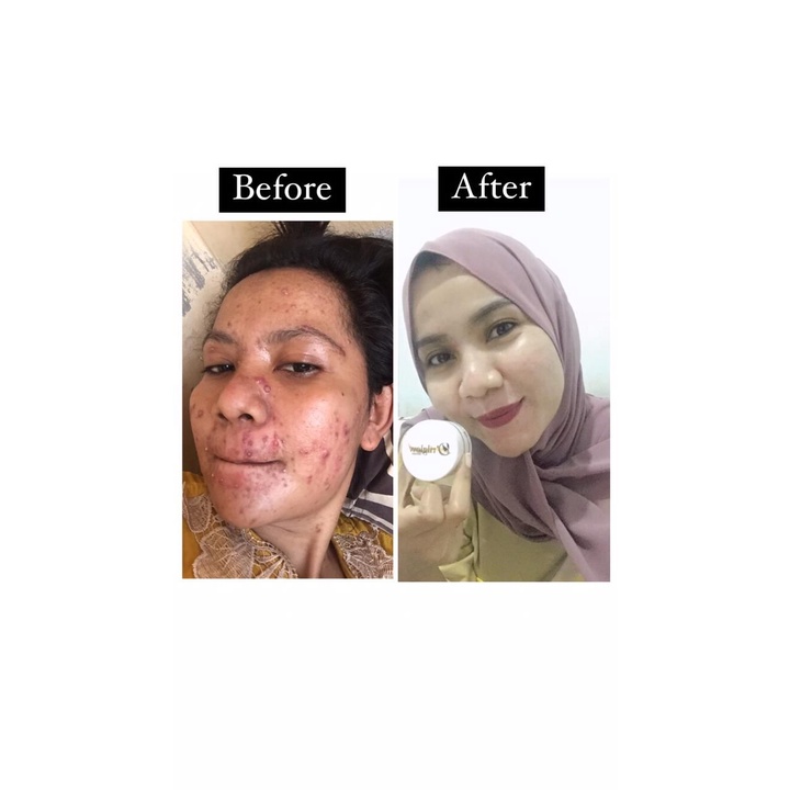 DrilGlow Original Paket Skincare Perawatan Wajah Glowing Paket Acne D'ril Glow BPOM HALAL
