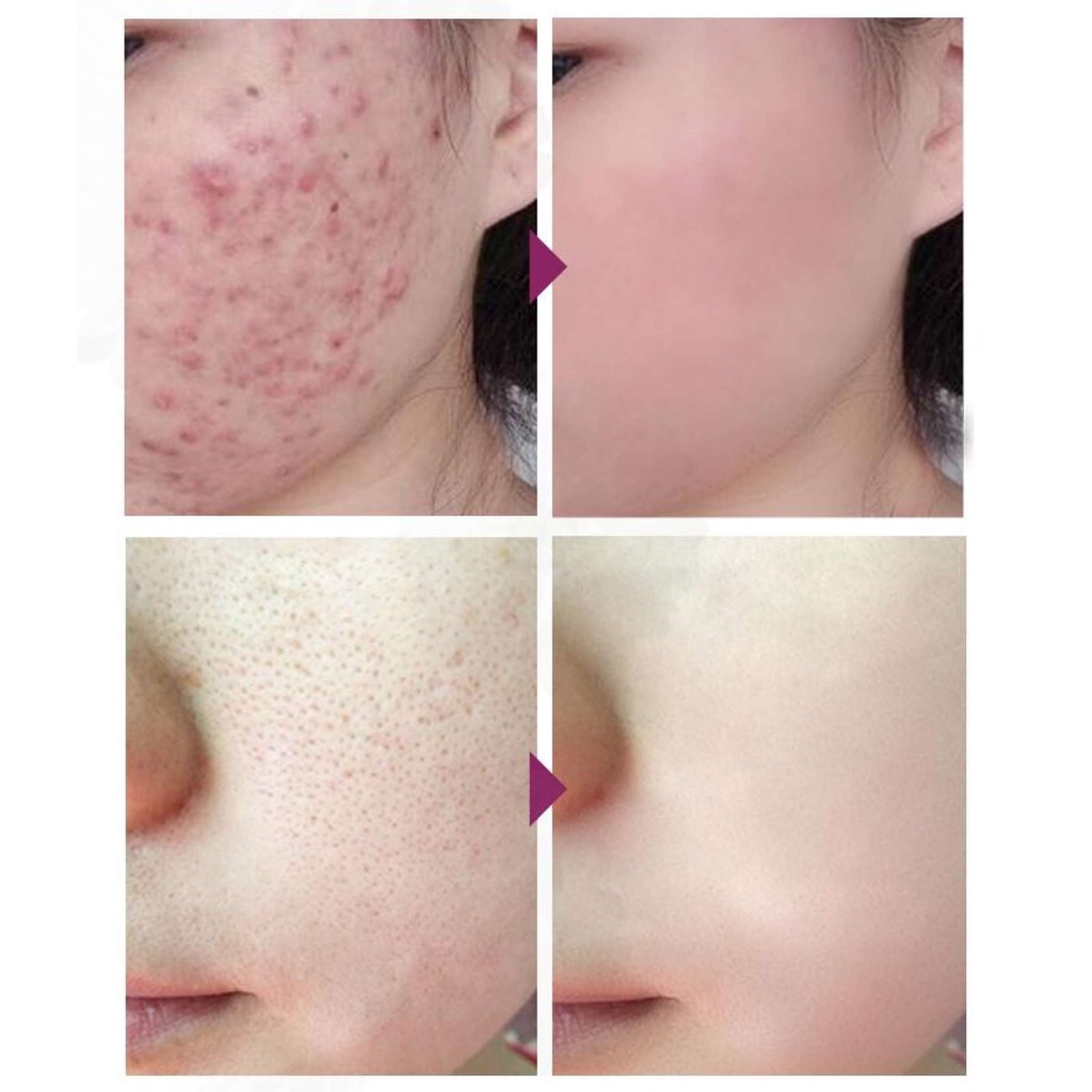 [Terbukti Alami] RtopR Perbaikan Anti Acne Krim Jerawat Pemutih Pelembab Krim Wajah Perawatan Anti-jerawat Krim Siang Pori-pori Pengecil Perawatan Kulit