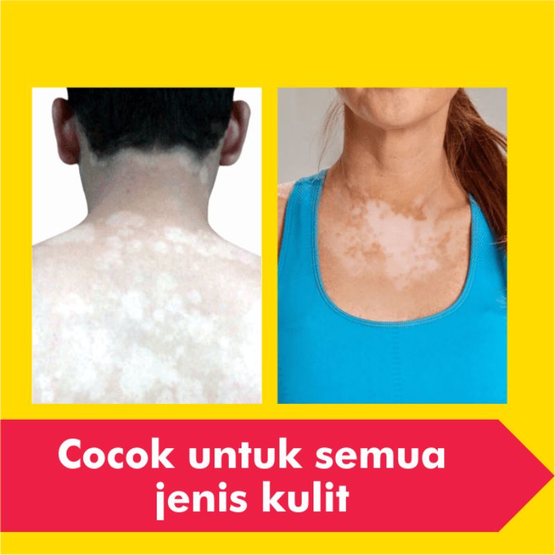 Obat Salep Panu Paling Ampuh Gatal Kurap Kutu Air Jamur Kulit Selangkangan Gatel Eksim Jerawat Kudis-4