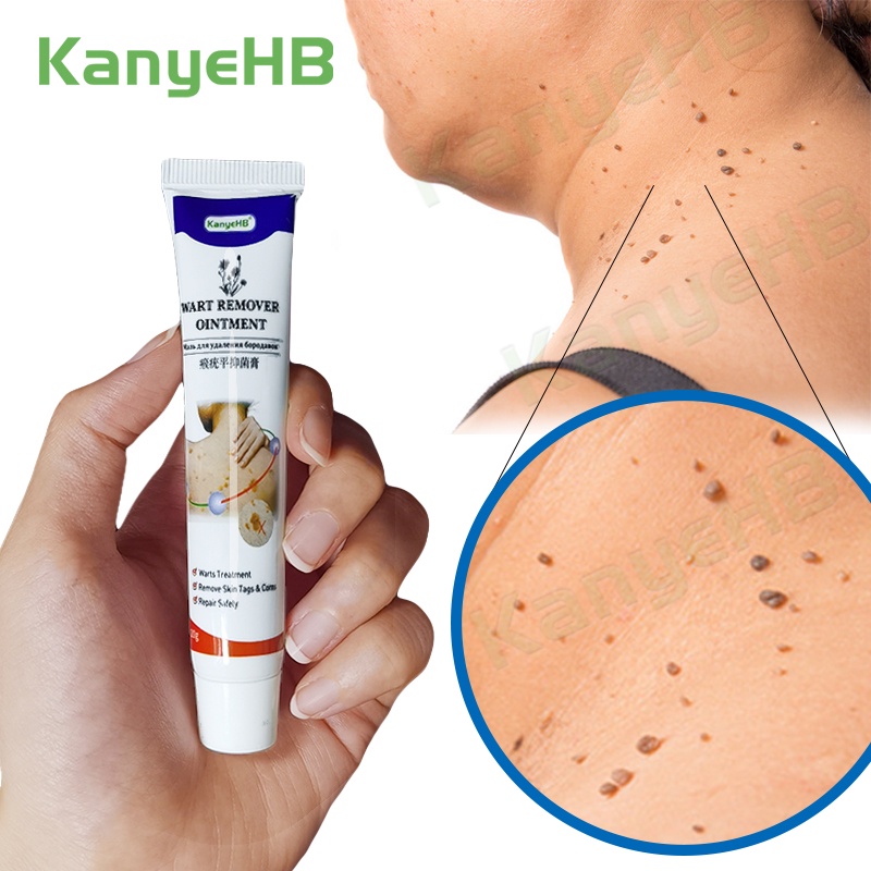 KanyeHB Skin Tag Remover Wart Remover Ointment 20g - Menghilangkan Kutil Tahi Lalat Mata Ikan