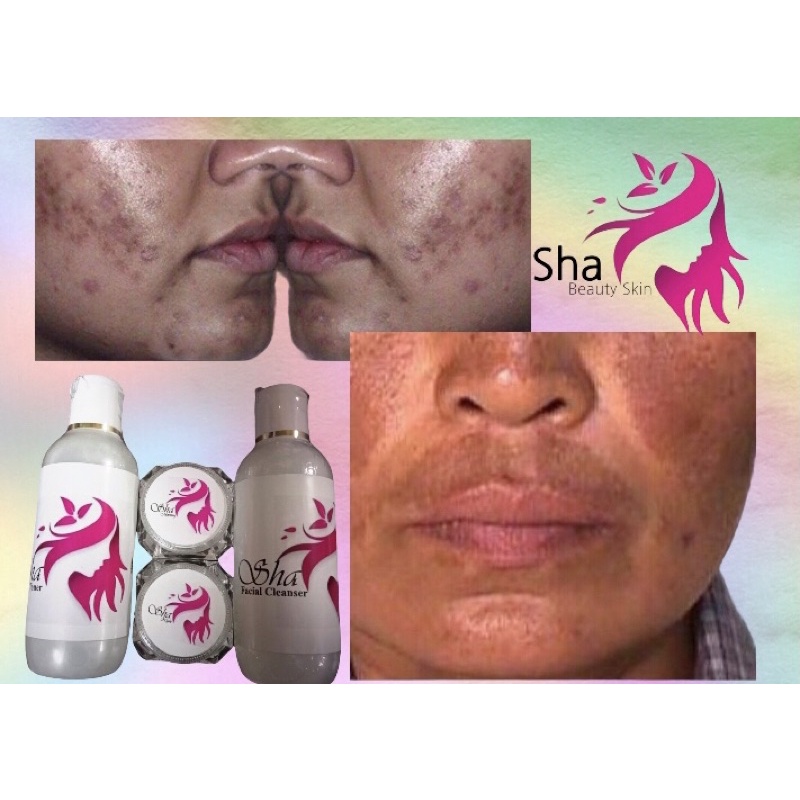 [ORIGINAL] CREAM JERAWAT , CREAM FLEK HITAM, FLEK MELASMA PRIA&WANITA