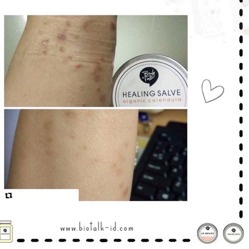 ➺ Biotalk Calendula Healing Salve for eczema and dry skin ❈