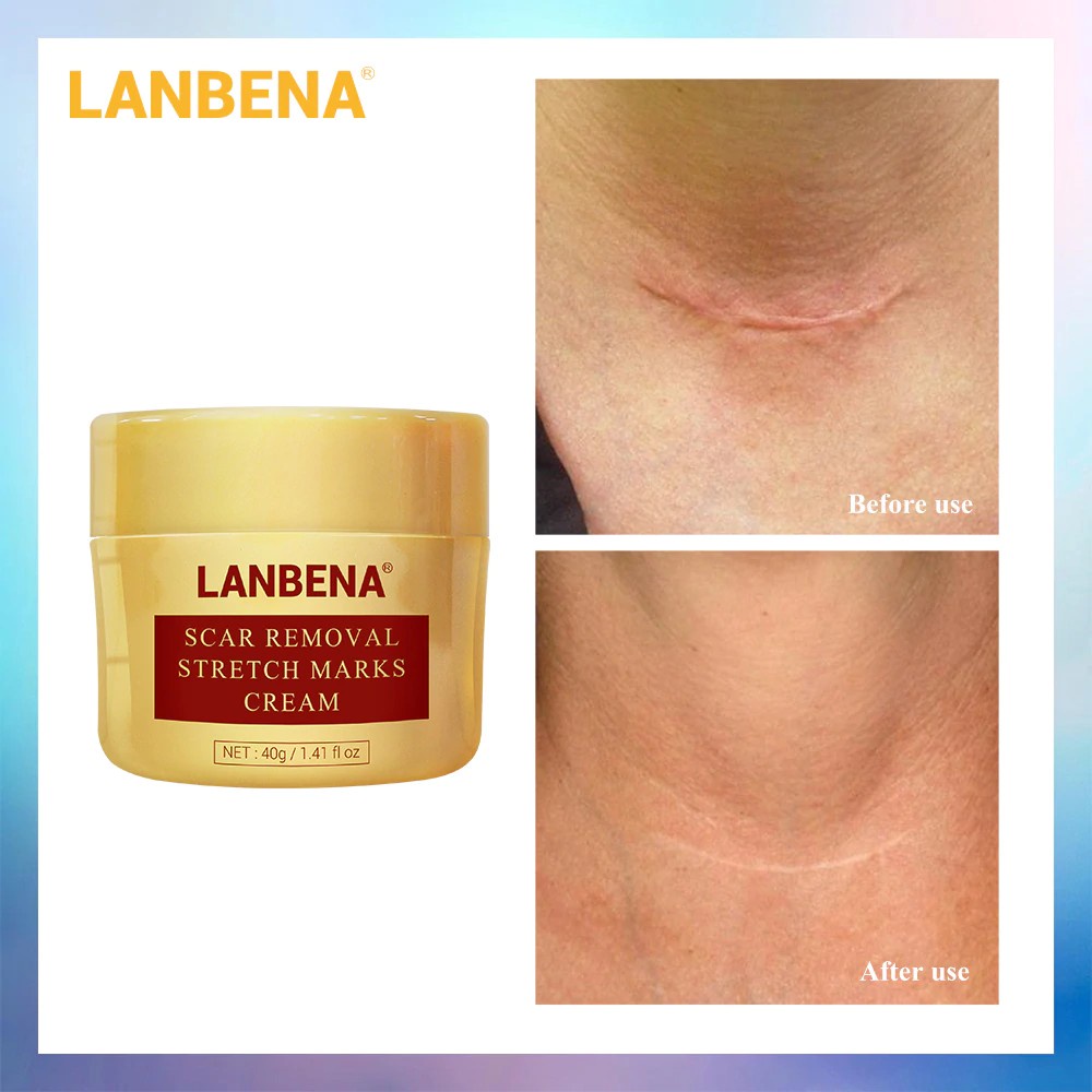 Lanbena Scar Removal Stret Marks Cream / krim Penghilang Bekas Luka / Oprasi