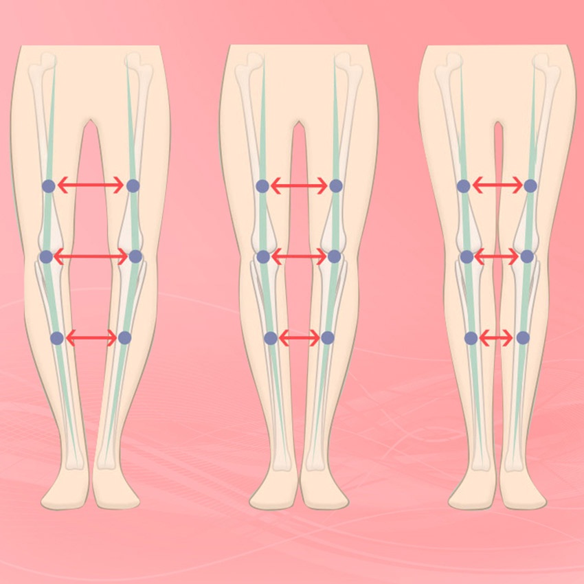 1 set Anak BARU postur Tersedia Semua Hari O / X jenis kaki membungkuk Kaki Lutut Valgum Meluruskan Sabuk Koreksi Band Postur Korektor