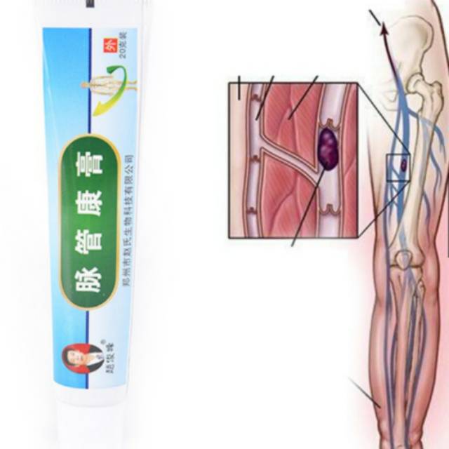 Salep varises terbaik obat penghilang varises