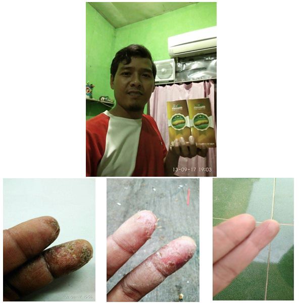 Obat Ujung Jari Kering Pecah Pecah Bersisik Dan Mengelupas Obat Oles Kulit Kering Dan Bersisik Shopee Indonesia