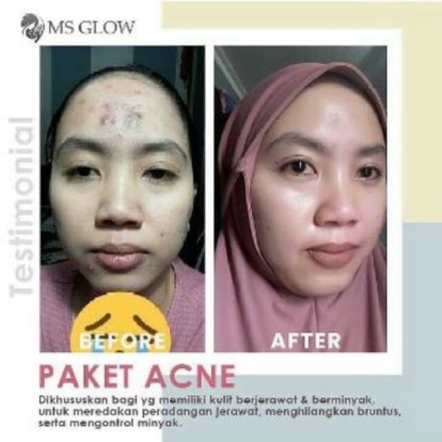 Produk Ms Glow Acne Series Shopee Indonesia