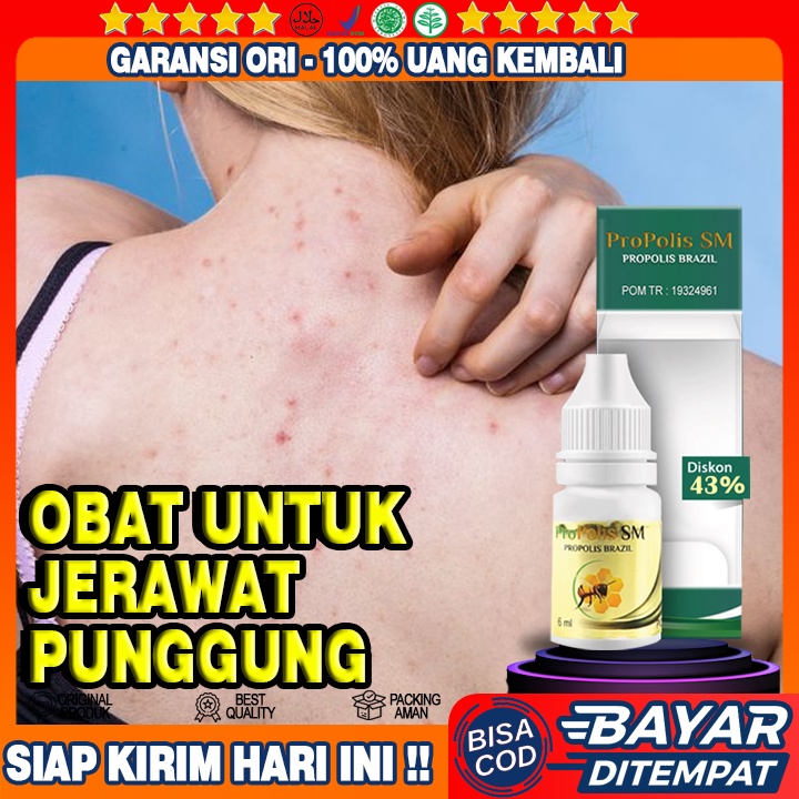 Obat Jerawat Punggung, Obat Penghilang Jerawat Punggung, Obat Oles Jerawat Punggung, Propolis SM