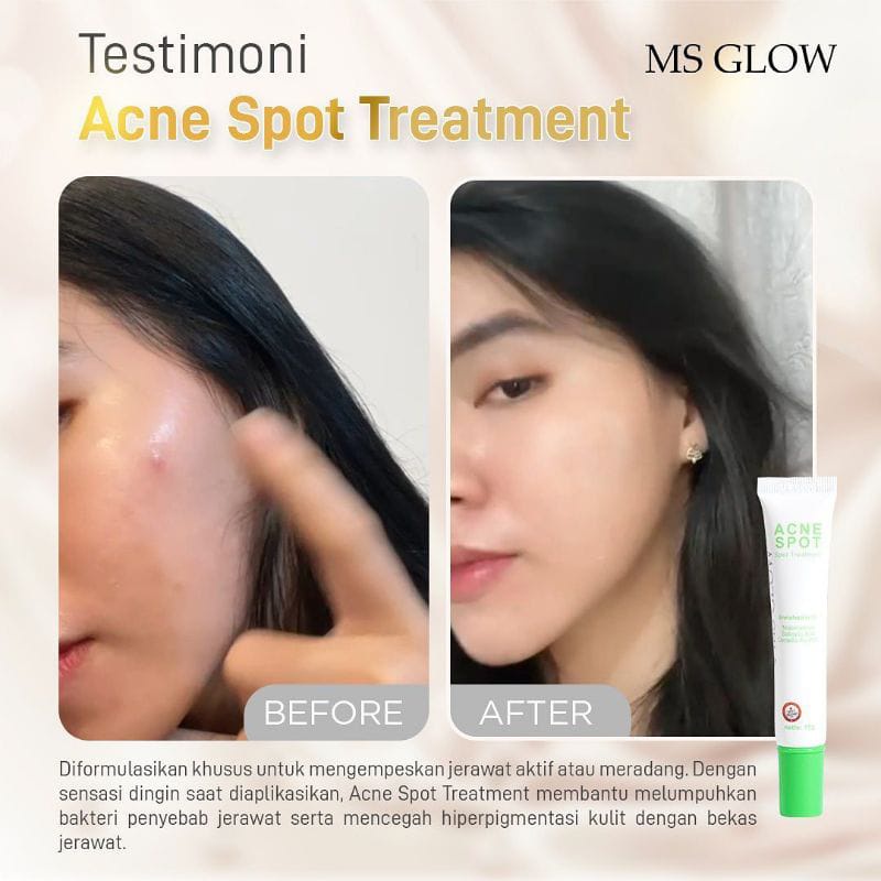 Ms Glow Acne Spot Serum Penghilang Jerawat Dan Bruntusan