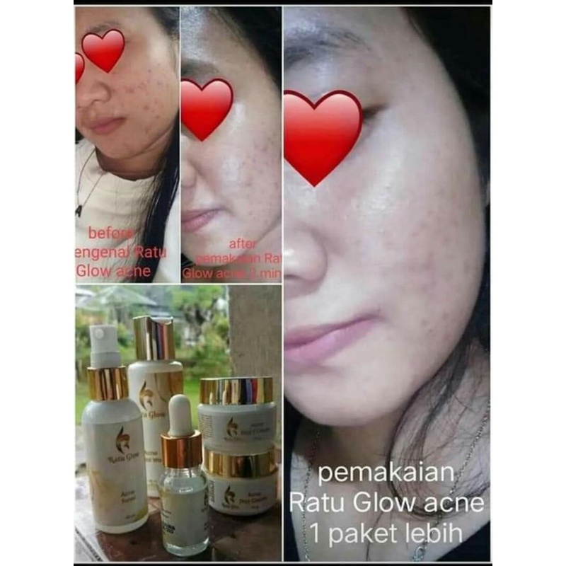RATU GLOW SKINCARE PAKET BRIGHTENING &amp; ACNE ORIGINAL PENCERAH WAJAH