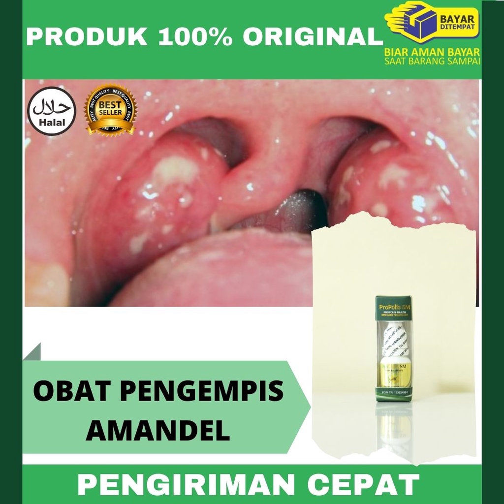 Jual Obat Amandel Kempis Alami, Batu Amandel, Obat Radang Amandel