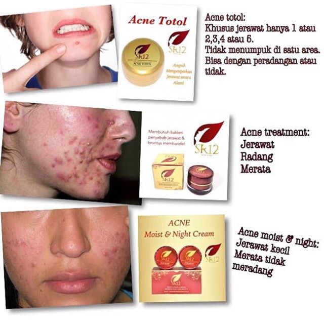 SR12 ACNE TREATMENT CREAM KRIM JERAWAT MERADANG &amp; MEMBANDEL AMPUH HILANGKAN JERAWAT