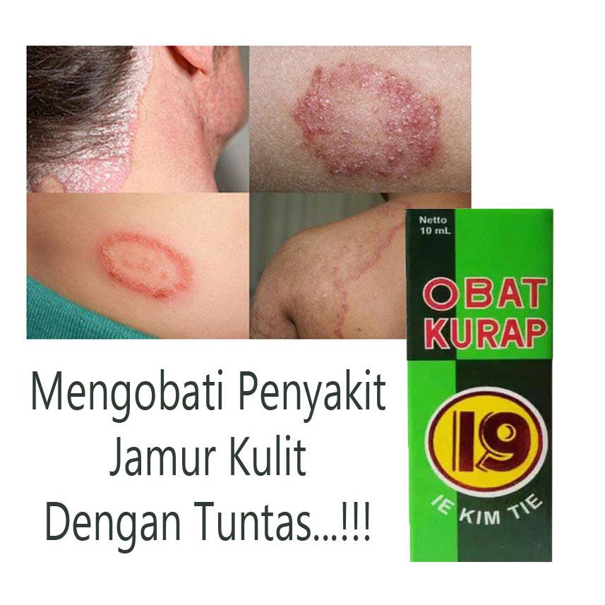 Obat Kurap Cap 19 [10 ml/Botol]