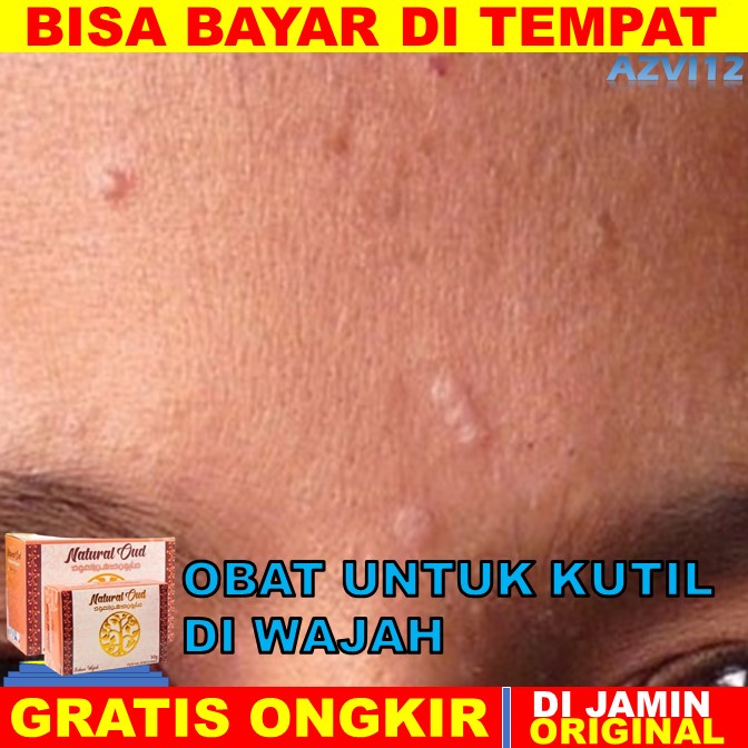 obat kutil di wajah  obat kutil Obat Kutil Di Wajah, Obat Kutil Di Leher, Obat Penghilang Kutil, Ski