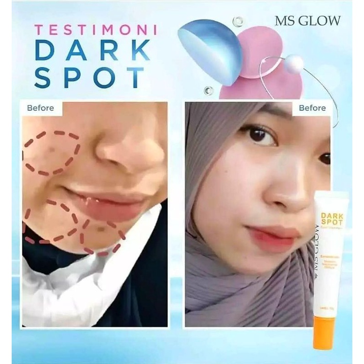 Dark Spot Treatment Serum II Khusus Flek MS GLOW