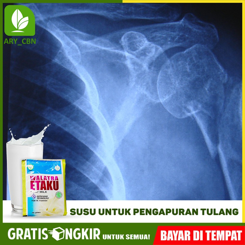 

Susu Untuk Pengapuran Tulang - Tulang Keropos - Patah Tulang Susu Kambing Murni Etaku di Cirebon