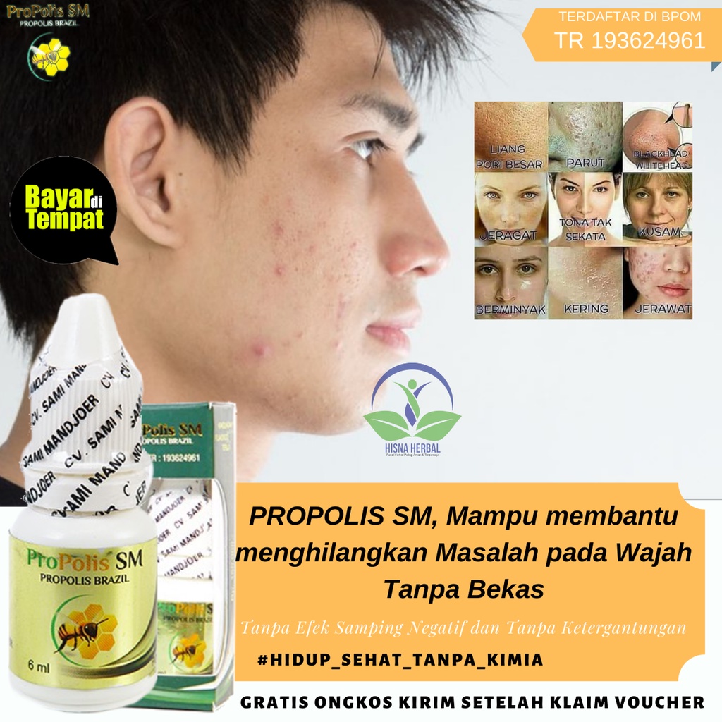 [ 100% ORIGINAL ] Obat Jerawat Bernanah dan Bernanah, Obat Jerawat Batu Di Dagu / Obat Jerawat Pada 